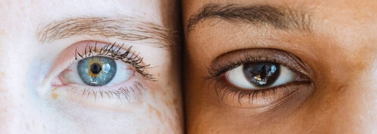 Why Do We Get Bags Under Our Eyes?