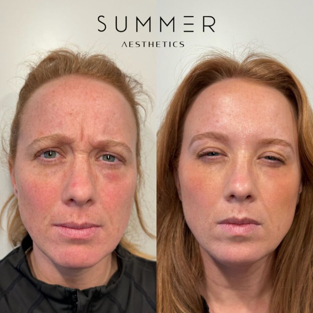 Botox 11s before and after