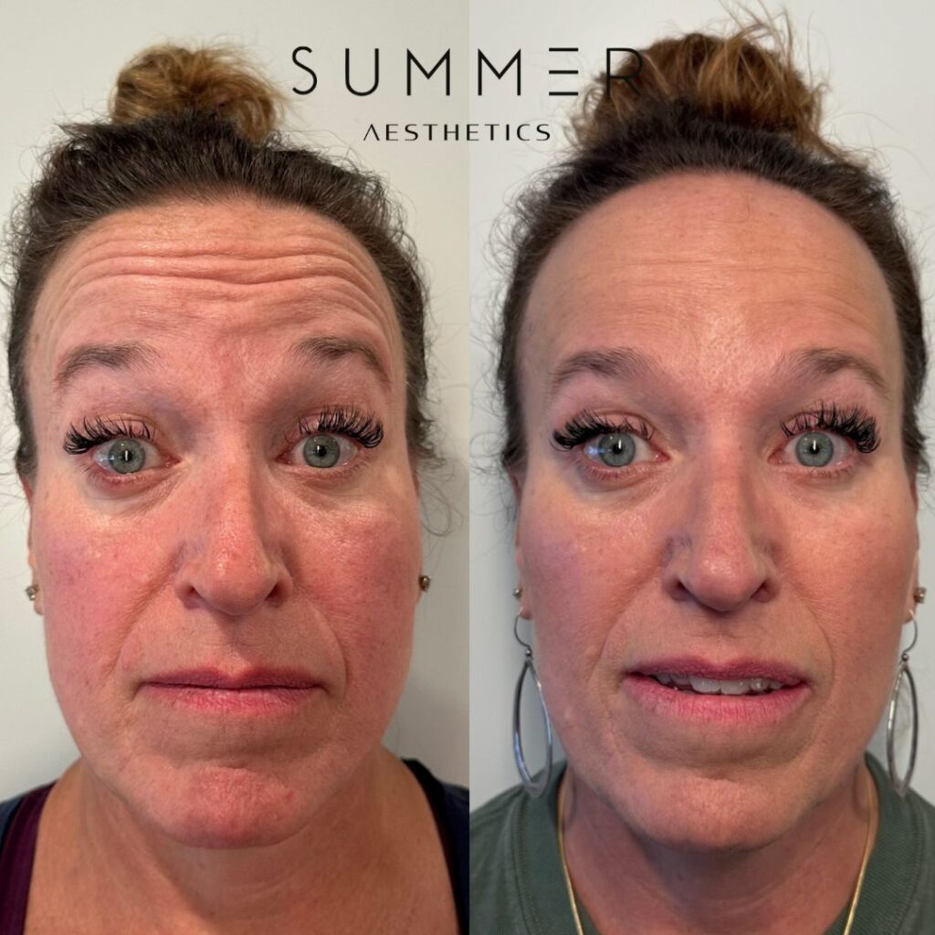 Full face botox before and after
