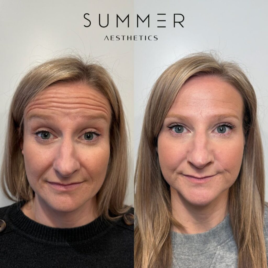Midface_Prejowl Filler before and after (3)