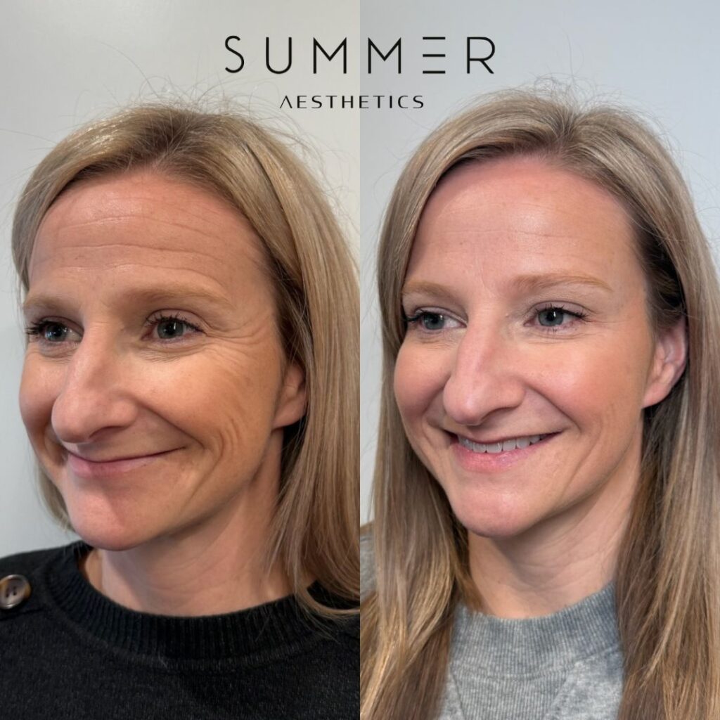 Midface_Prejowl Filler before and after (4)