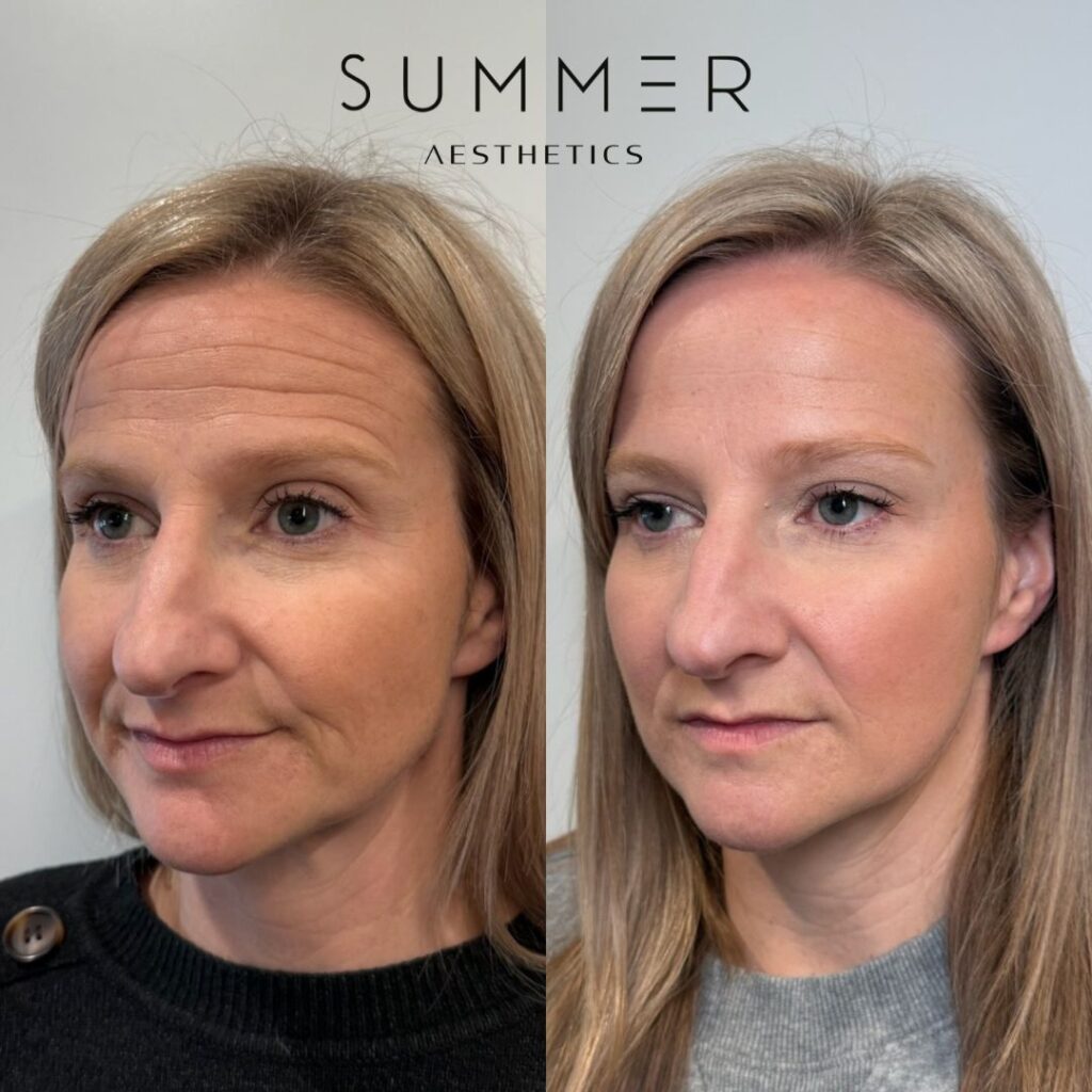 Midface_Prejowl Filler before and after (6)