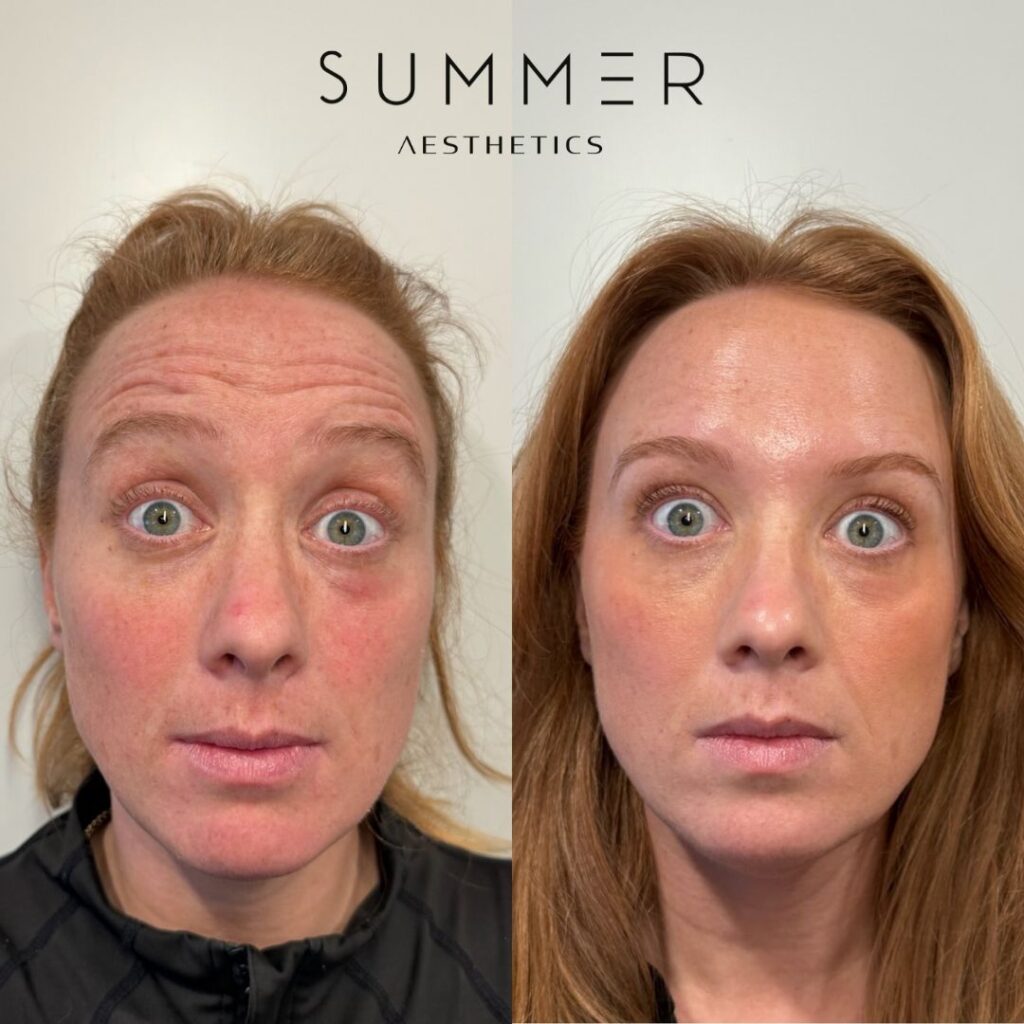 female botox forehead before and after
