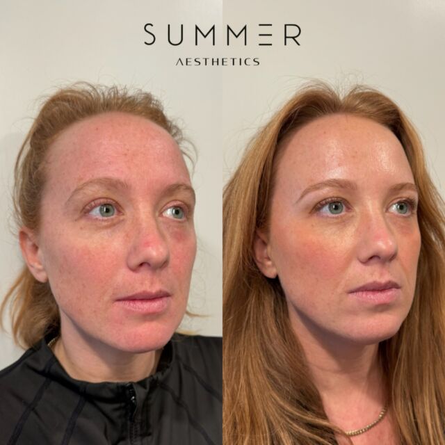 These results are two weeks post Botox treatment, and you can noticeably see the glow to her skin. When used in the upper face (forehead, frown lines, crow’s feet), Botox relaxes muscles to smooth out fine lines and prevent deeper creases from forming. The result? A more refreshed, youthful look—without losing natural expression.  📱Call/text 503-388-3334 to book, for training/shadowing, or anything you need!  📍Lake Oswego, OR 📍Ridgefield, WA 📧 hello@summermedspa.com 💻 SummerMedspa.com  👩🏼‍⚕️Nikki Hassell PA-C (@injectormissnik) 👩🏼‍⚕️Maddy Hough RN BSN (@injector.maddy) 👩🏻‍⚕️Emily Fogg CAE (@sweetlikehoneyskin)  👩🏼‍⚕️Taryn Letzring CAE (@skinby.taryn) 👩🏼‍⚕️Summer Harness FNP-BC CANS (@summerchantal)