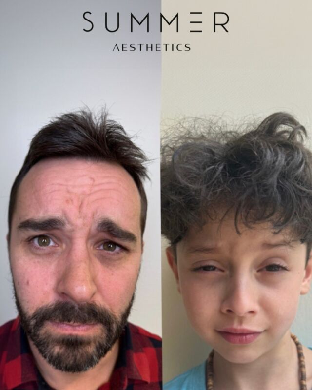 The results after one session with Nikki! Can you guess what treatment she did here? Comment the right answer to get a chance to win a $100 off your next treatment!!!   #Portland #LakeOswego #Aesthetics  📱Call/text 503-388-3334 to book, for training/shadowing, or anything you need!  📍Lake Oswego, OR 📍Ridgefield, WA 📧 hello@summermedspa.com 💻 SummerMedspa.com  👩🏼‍⚕️Nikki Hassell PA-C (@injectormissnik) 👩🏼‍⚕️Maddy Hough RN BSN (@injector.maddy) 👩🏻‍⚕️Emily Fogg CAE (@sweetlikehoneyskin)  👩🏼‍⚕️Taryn Letzring CAE (@skinby.taryn) 👩🏼‍⚕️Summer Harness FNP-BC CANS (@summerchantal)