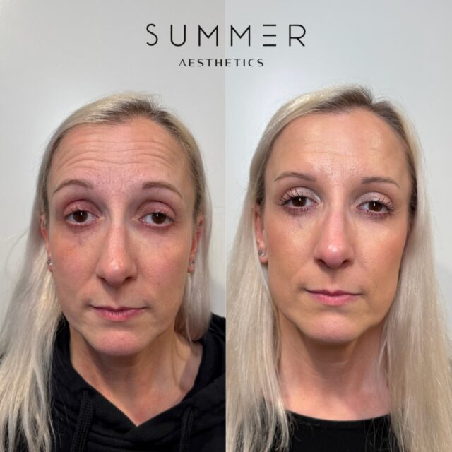 When most people think of Botox, they focus on the upper face—forehead lines, crow's feet, and frown lines. But to truly age naturally and maintain facial harmony, it's just as important to treat the lower face.  As we age, the muscles in the lower face can also show signs of sagging or tension, leading to jawline jowls, chin dimples, and a more "tired" appearance. By incorporating Botox into the lower face, we can:  -Lift the jawline and soften the appearance of jowls -Smooth the chin area to prevent dimpling -Relax the muscles around the mouth to reduce smile lines and creases  When Botox is used strategically across the full face, it helps maintain symmetry, restores volume, and keeps the skin looking youthful without losing your natural expression.  For this patient in particular, here are all of the areas we treated for the most natural result: -forehead -glabella (11's) -crows feet -DAOs (next to the mouth to prevent downturned smile) -chin -lip flip + gummy smile  📱Call/text 503-388-3334 to book, for training/shadowing, or anything you need!  📍Lake Oswego, OR 📍Ridgefield, WA 📧 hello@summermedspa.com 💻 SummerMedspa.com  👩🏼‍⚕️Nikki Hassell PA-C (@injectormissnik) 👩🏼‍⚕️Maddy Hough RN BSN (@injector.maddy) 👩🏻‍⚕️Emily Fogg CAE (@sweetlikehoneyskin)  👩🏼‍⚕️Taryn Letzring CAE (@skinby.taryn) 👩🏼‍⚕️Summer Harness FNP-BC CANS (@summerchantal)