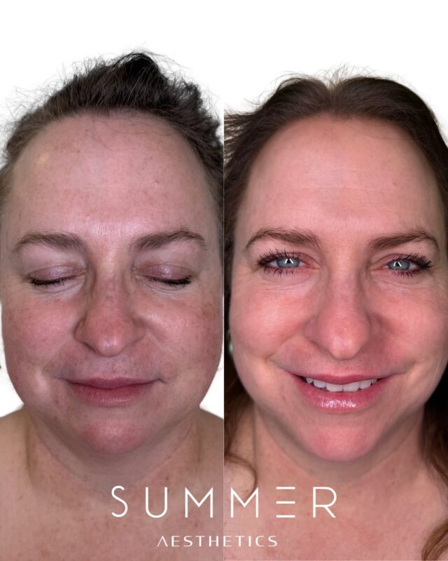 WOW 🤩 These results speak for themselves! This patient was beyond thrilled with the transformation after just one BBL + MOXI session. These two treatments work together to target pigment, texture, and tone for noticeably brighter, clearer skin. Curious what this combo can do for you? Scroll through to see for yourself! 😍 Book a consultation—we’d love to create a plan tailored to your skin goals!😇❤️   Questions, private training, bookings, anything you need! 🥳 hello@summermedspa.com - BOOK WITH US: 👇🏻👇🏻 📍Lake Oswego, OR 📍Ridgefield, WA 📧 hello@summermedspa.com 💻 summermedspa.com 👩🏼‍⚕️Nikki Hassell PA-C (@injectormissnik) 👩🏼‍⚕️Maddy Hough RN BSN (@injector.maddy) 👩🏻‍⚕️Emily Fogg CAE (@sweetlikehoneyskin) 👩🏼‍⚕️Taryn Letzring CAE (@skinby.taryn) 👩🏼‍⚕️ Summer Harness FNP-BC CANS (@summerchantal)   #scitonbbl #MOXI #sundamage #lakeoswego #lakeoswegobeauty #beautiful