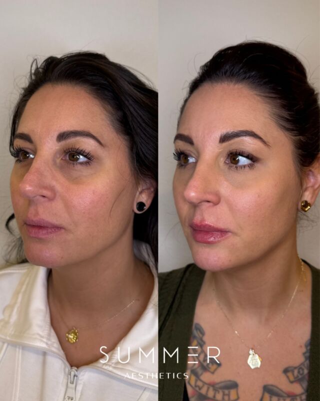 Facial balancing is all about enhancing your natural beauty in a way that looks effortless and natural. By using a combination of neurotoxins and dermal fillers we can smooth lines, add definition, and create a more balanced, refreshed appearance—without making you look overdone.  📍 Curious about facial balancing? Let’s chat about what’s best for you! 💖  📱Call/text 503-388-3334 to book, for training/shadowing, or anything you need!  📍Lake Oswego, OR 📍Ridgefield, WA 📧 hello@summermedspa.com 💻 SummerMedspa.com  👩🏼‍⚕️Nikki Hassell PA-C (@injectormissnik) 👩🏼‍⚕️Maddy Hough RN BSN (@injector.maddy) 👩🏻‍⚕️Emily Fogg CAE (@sweetlikehoneyskin)  👩🏼‍⚕️Taryn Letzring CAE (@skinby.taryn) 👩🏼‍⚕️Summer Harness FNP-BC CANS (@summerchantal)  #FacialBalancing #Portland #GlowUp #AestheticBeauty #ConfidenceBoost #Lake Oswego #Botox #DermalFiller