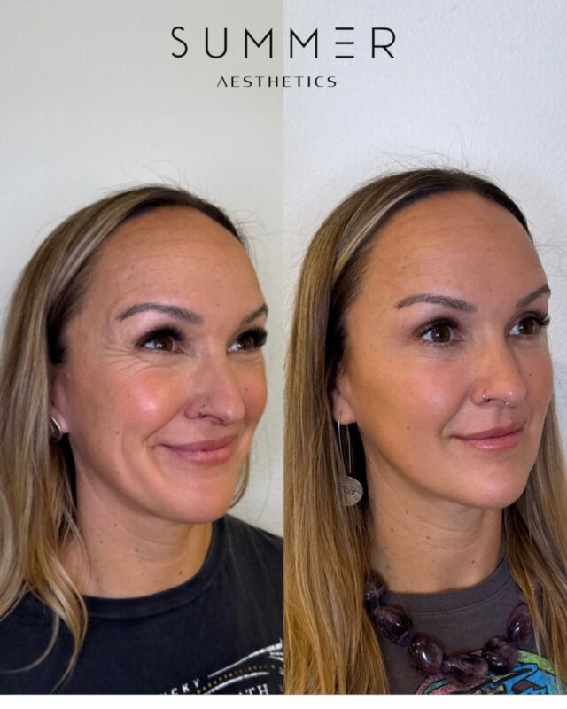 Smooth, lifted, and naturally balanced, full-face Botox and dermal fillers work together to enhance your features without looking overdone. By softening fine lines, adding subtle volume, and sculpting key areas like temples, mid face, and chin, facial balancing creates harmony and symmetry for a refreshed, youthful look. ✨ #FacialBalancing #NaturalBeauty #BotoxAndFiller #LakeOswego #Portland #Aesthetics  📱Call/text 503-388-3334 to book, for training/shadowing, or anything you need!  📍Lake Oswego, OR 📍Ridgefield, WA 📧 hello@summermedspa.com 💻 SummerMedspa.com  👩🏼‍⚕️Nikki Hassell PA-C (@injectormissnik) 👩🏼‍⚕️Maddy Hough RN BSN (@injector.maddy) 👩🏻‍⚕️Emily Fogg CAE (@sweetlikehoneyskin)  👩🏼‍⚕️Taryn Letzring CAE (@skinby.taryn) 👩🏼‍⚕️Summer Harness FNP-BC CANS (@summerchantal)