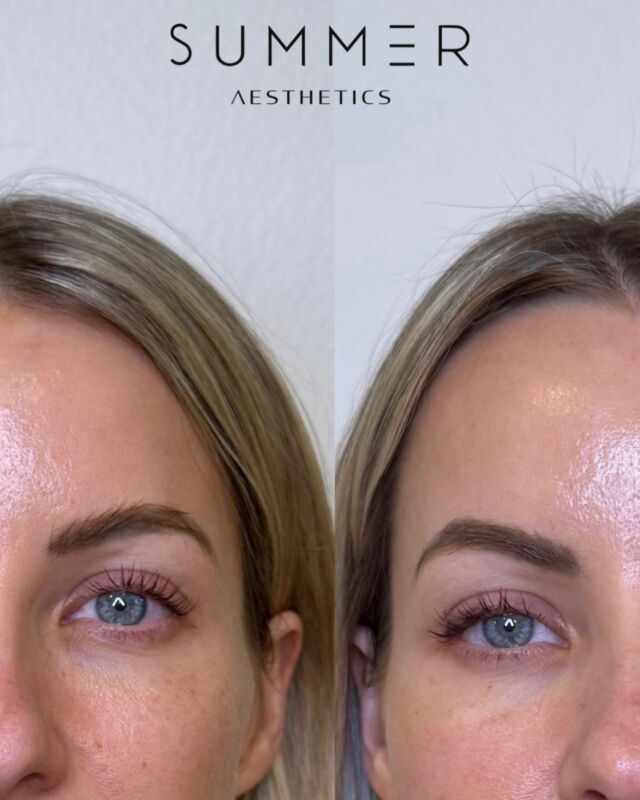 Skinvive is one of our FAVORITE treatments!! 💫  Designed to boost skin hydration, improve texture, and enhance overall radiance. Unlike traditional fillers, it doesn’t add volume but instead infuses the skin with hyaluronic acid, helping to smooth fine lines and create a naturally refreshed look. Results can last up to six months, keeping the skin hydrated, plump, and glowing for an extended period. Skinvive provides a subtle yet noticeable improvement, leaving your skin looking healthier, smoother, and more radiant. If you're looking for a simple way to achieve a long-lasting glow, Skinvive might be the perfect choice!  📱Call/text 503-388-3334 to book, for training/shadowing, or anything you need!  📍Lake Oswego, OR 📍Ridgefield, WA 📧 hello@summermedspa.com 💻 SummerMedspa.com  👩🏼‍⚕️Nikki Hassell PA-C (@injectormissnik) 👩🏼‍⚕️Maddy Hough RN BSN (@injector.maddy) 👩🏻‍⚕️Emily Fogg CAE (@sweetlikehoneyskin)  👩🏼‍⚕️Taryn Letzring CAE (@skinby.taryn) 👩🏼‍⚕️Summer Harness FNP-BC CANS (@summerchantal)