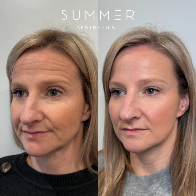Starting the week off with these incredible Botox results! 😍 Neurotoxin treatments bring out a refreshed version of you without making you look “frozen” or unnatural 👏 If you’ve been waiting to get Botox, this is your sign to schedule with Summer Aesthetics! 😉   ✨Treatment deets✨ 7” units of full face Botox done including forehead, 11’s, crows feet, frown lines/DAO, and chin! Honestly… Her lower face results are ❤️‍🔥❤️‍🔥❤️‍🔥… Just another reason to not forget your lower face!! 😝😬  📱Call/text 503-388-3334 to book, for training/shadowing, or anything you need! ❤️  📍Lake Oswego, OR 📍 Ridgefield, WA 📧 hello@summermedspa.com 💻 SummerMedspa.com  👩🏼‍⚕️Nikki Hassell PA-C (@injectormissnik) 👩🏼‍⚕️Maddy Hough RN BSN (@injector.maddy) 👩🏻‍⚕️Emily Fogg CAE (@sweetlikehoneyskin) 👩🏼‍⚕️Taryn Letzring CAE (@skinby.taryn) 👩🏼‍⚕️Summer Harness FNP-BC CANS (@summerchantal)  #botox #dysport #neurotoxin #wrinklerelaxers #medicalaesthetics #injectables #cosmeticinjectables #aestheticinjector #medicalspa #medspa #nurseinjector #aestheticinjections #cosmeticinjector #injector #selfcare #antiaging