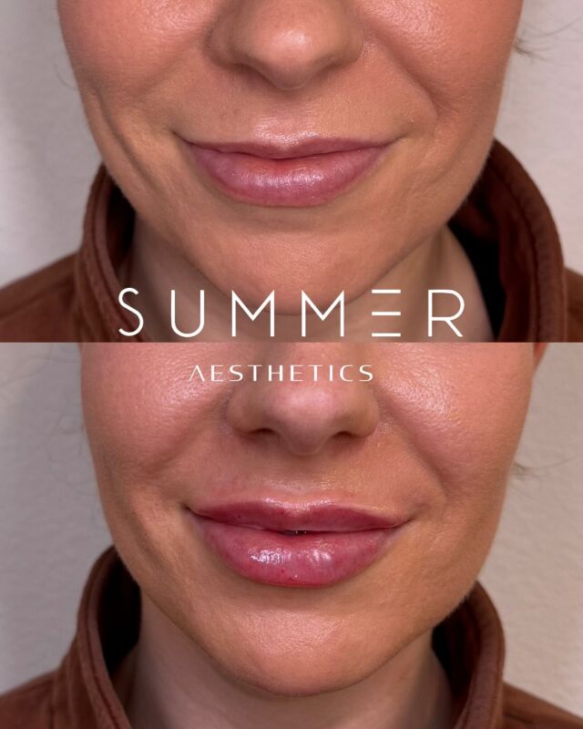 ✨ Lips worth loving! ✨ Check out this stunning before-and-after transformation - subtle, balanced, and perfectly plumped for a natural look. 💋 Ready to enhance your pout? Tag a friend who you’d want to book your lip appointment with and let’s plan a beauty date together! 💉💕 *Photos taken immediately post injection* #LipGoals #NaturalEnhancements #PoutPerfection #medspa #lakeoswego #injectables #juvederm #restylane