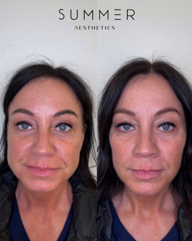 ✨ Better Together: PRF, Filler & Neurotoxin! ✨  Why choose just one when you can get even better results by combining treatments? Here’s why this trio is a game-changer:  ✔️ PRF (Platelet-Rich Fibrin) – Boosts collagen, improves skin texture, and enhances healing naturally. ✔️ Filler – Restores lost volume, smooths lines, and enhances facial contours. ✔️ Neurotoxin – Softens wrinkles and prevents new ones from forming.  Each treatment does something different, but together? They create a balanced, natural, and refreshed look—without looking overdone.  #chinfiller #botox #aesthetics #lakeoswego #portland #prf  📱Call/text 503-388-3334 to book, for training/shadowing, or anything you need!  📍Lake Oswego, OR 📍Ridgefield, WA 📧 hello@summermedspa.com 💻 SummerMedspa.com  👩🏼‍⚕️Nikki Hassell PA-C (@injectormissnik) 👩🏼‍⚕️Maddy Hough RN BSN (@injector.maddy) 👩🏻‍⚕️Emily Fogg CAE (@sweetlikehoneyskin)  👩🏼‍⚕️Taryn Letzring CAE (@skinby.taryn) 👩🏼‍⚕️Summer Harness FNP-BC CANS (@summerchantal)